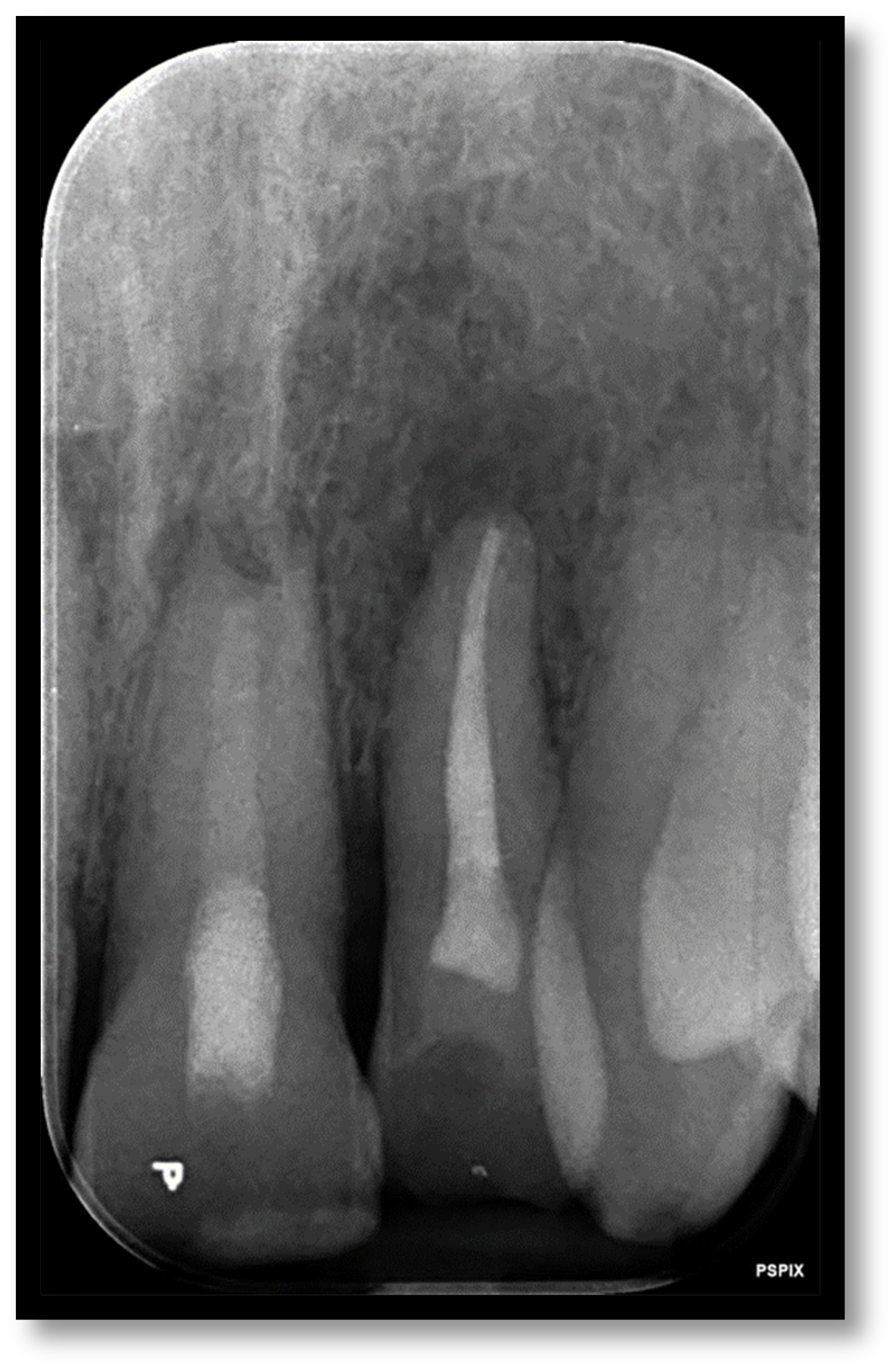 Dental trauma management - 6 month review case 2